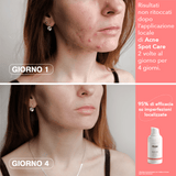 Acne Spot Care